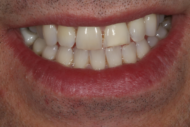 Before dental veneers