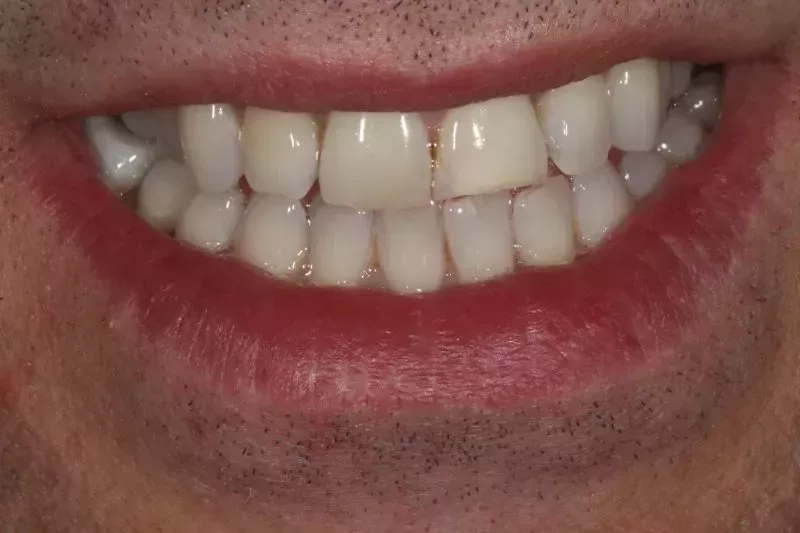 Before dental veneers