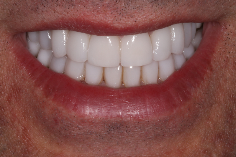 After dental veneers