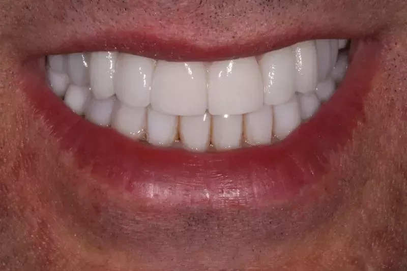 After dental veneers