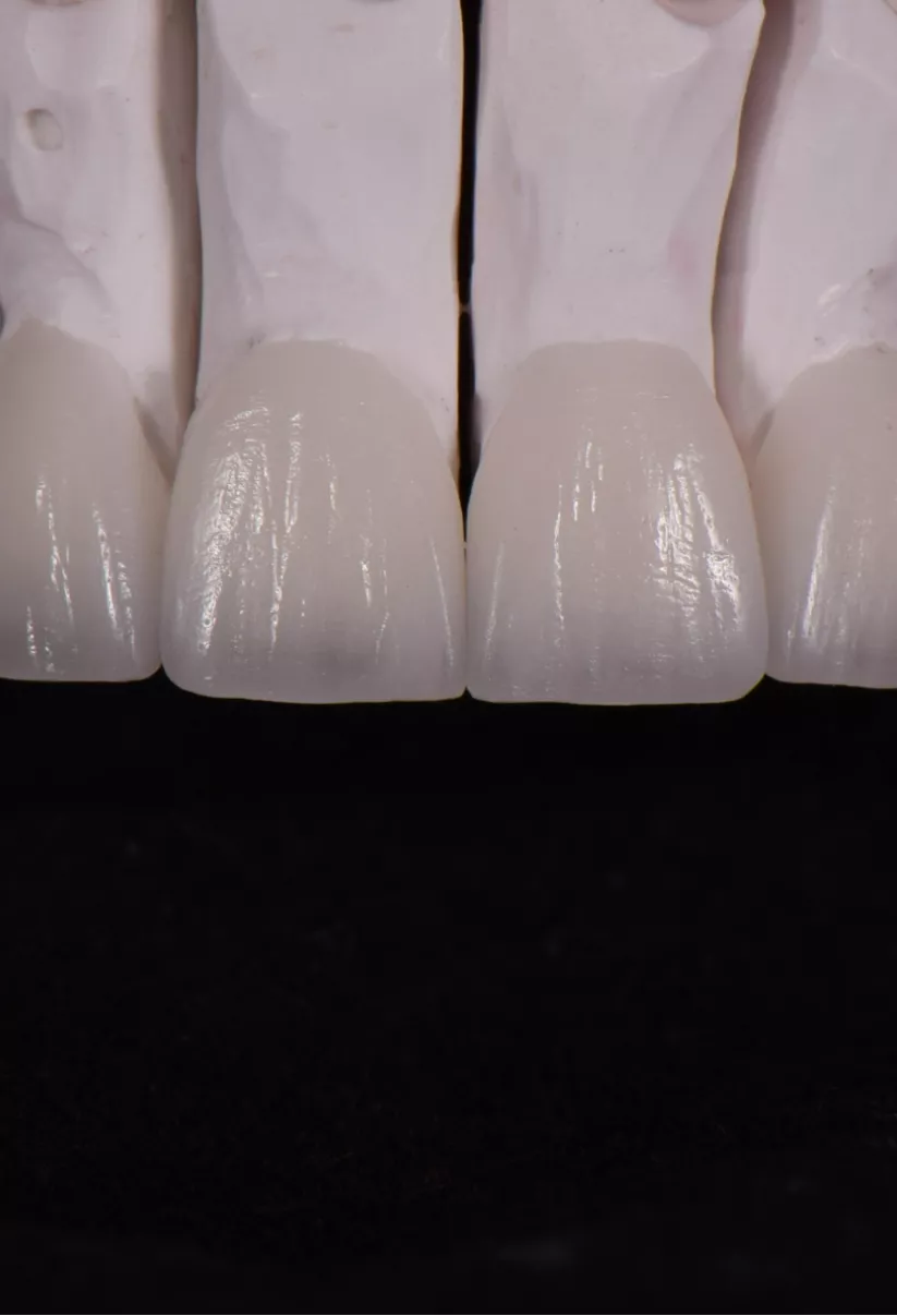 Lifelike Veneers TKC The highest quality porcelain veneers by Dr Sheraz Aleem