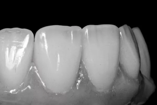 by Celebrity celebrity ceramist Craig Galbraith Premium veneer made by a master ceramist in California