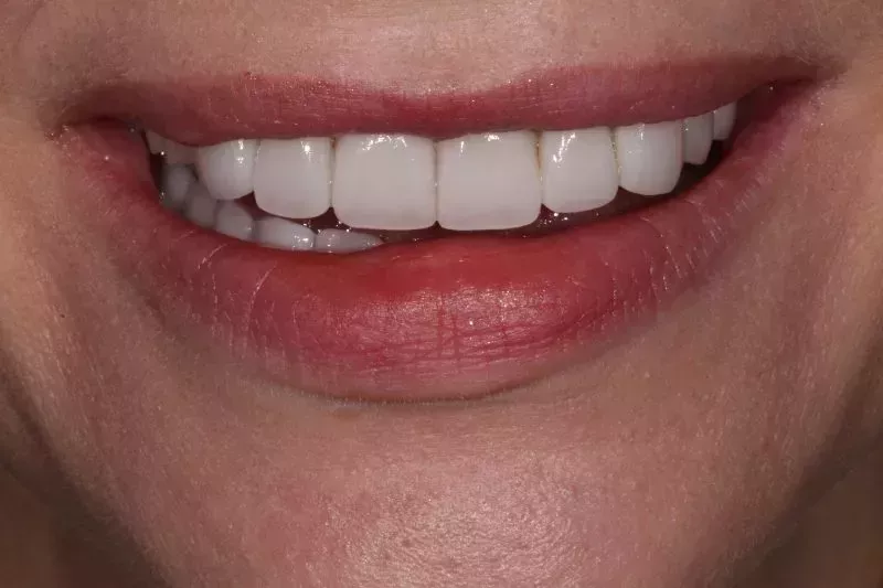 Smile design by Dr Aleem