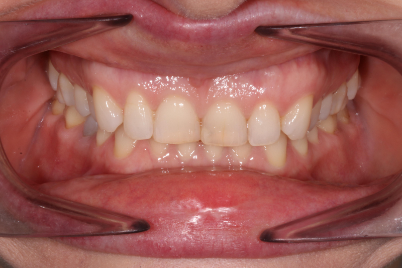 Before full mouth dental veneers