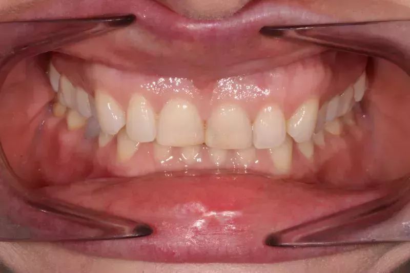 Before full mouth dental veneers