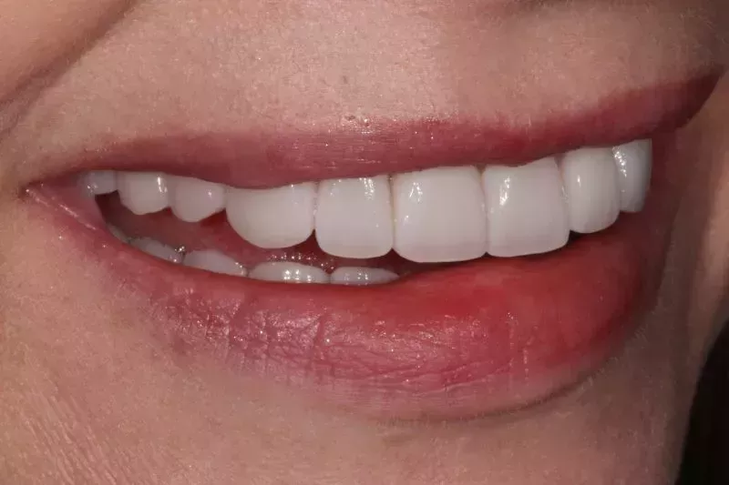 Smile design by Dr Aleem