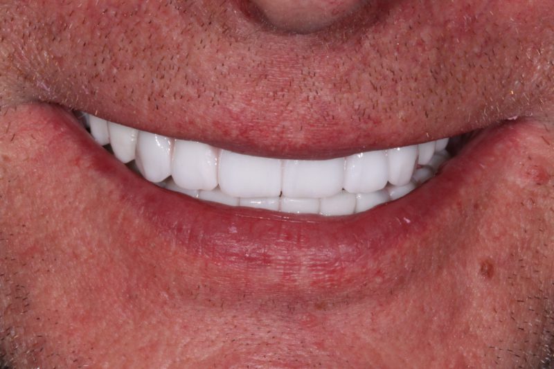 After full mouth dental implants