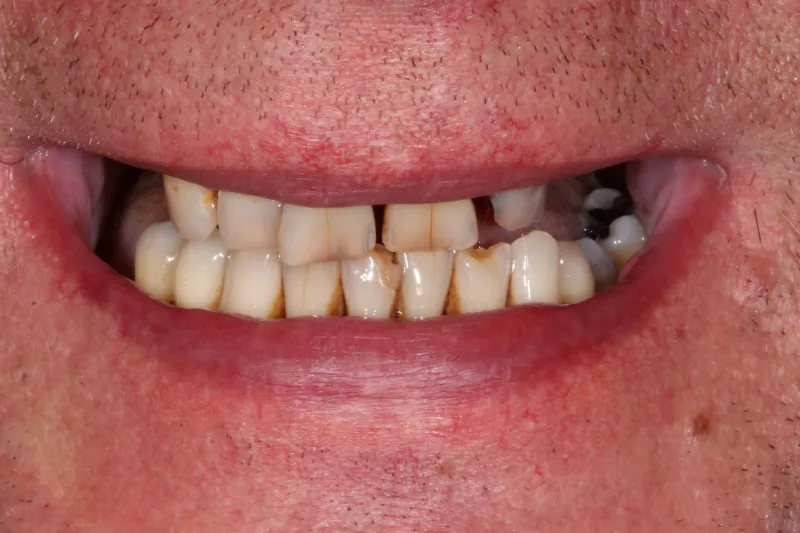 Missing teeth before dental implants