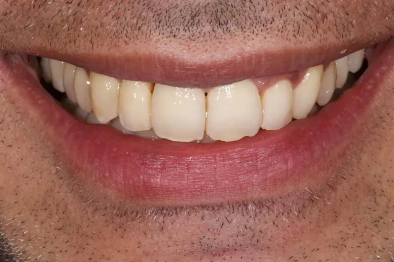 After Invisalign After Invisalign Results