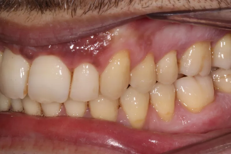 After Invisalign After Invisalign