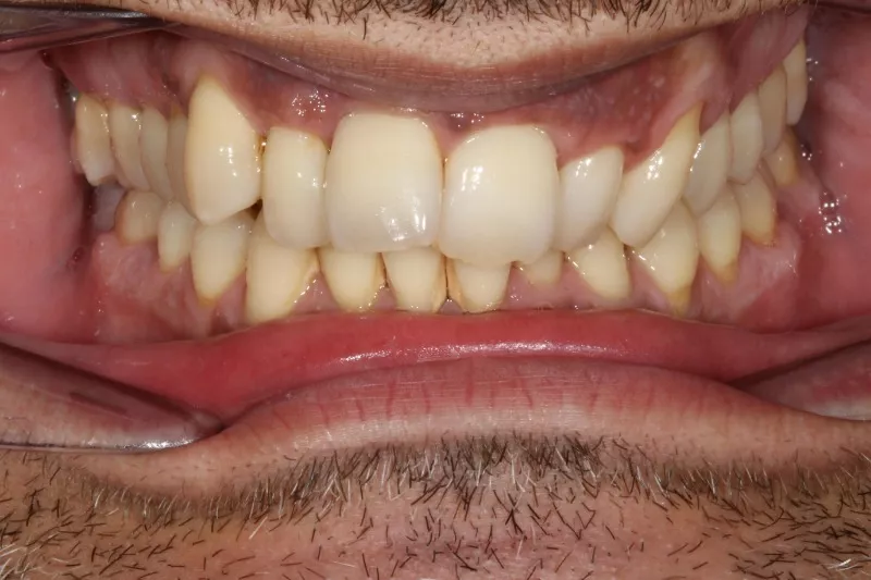 Before Invisalign Before Invisalign