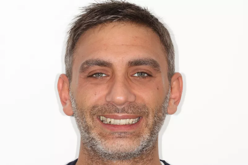 Before Invisalign treatment Before Invisalign treatment