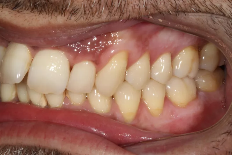 Before Invisalign Before Invisalign