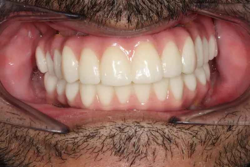 After full mouth dental implants