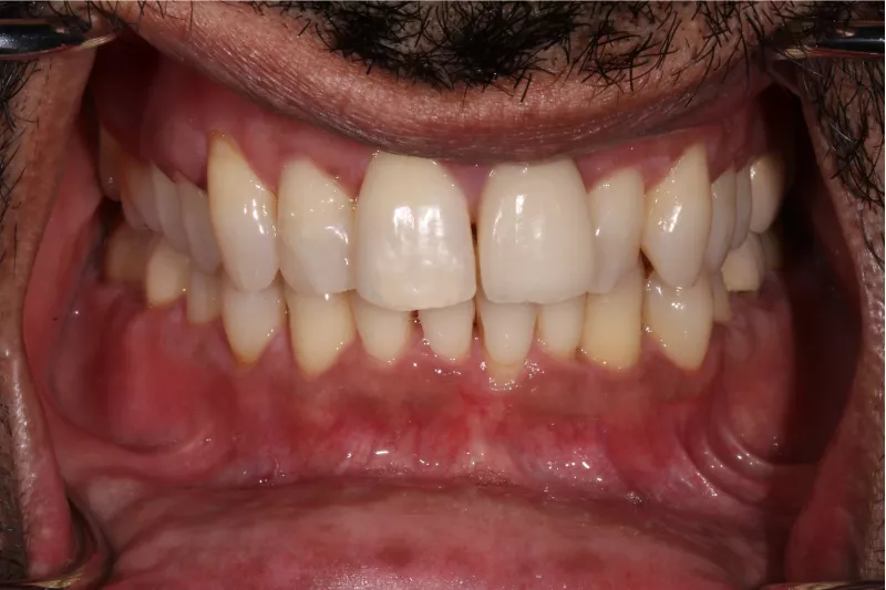 Before Invisalign Before Invisalign