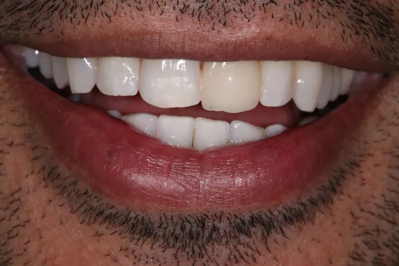 After Invisalign Invisalign lite results