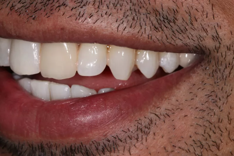 After Invisalign Invisalign lite results