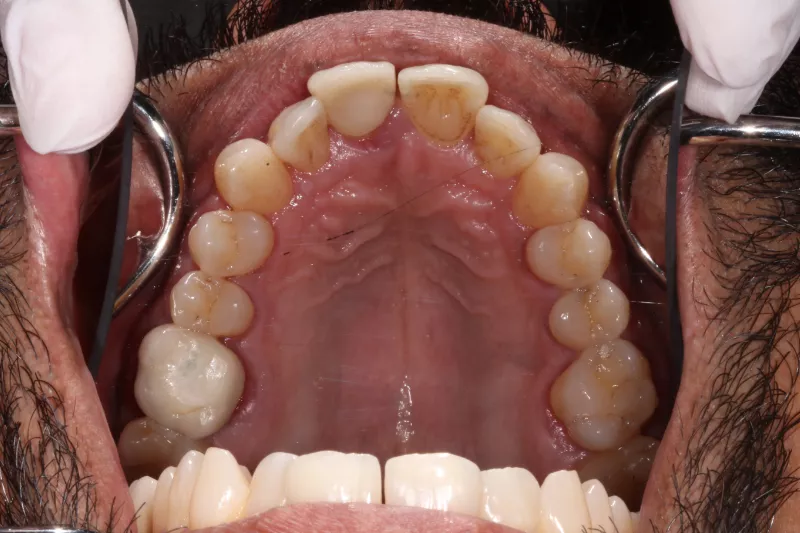 Before Invisalign Before Invisalign