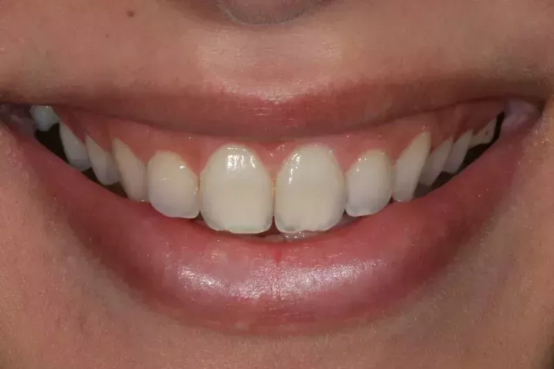 Results after one appointment for Gum contour with Waterlase laser
