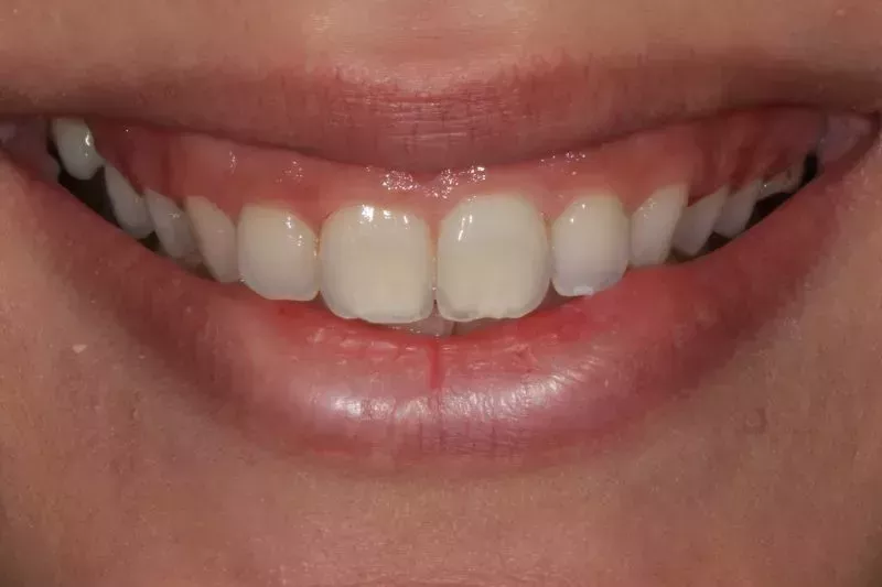 Before Gum contour with Waterlase laser
