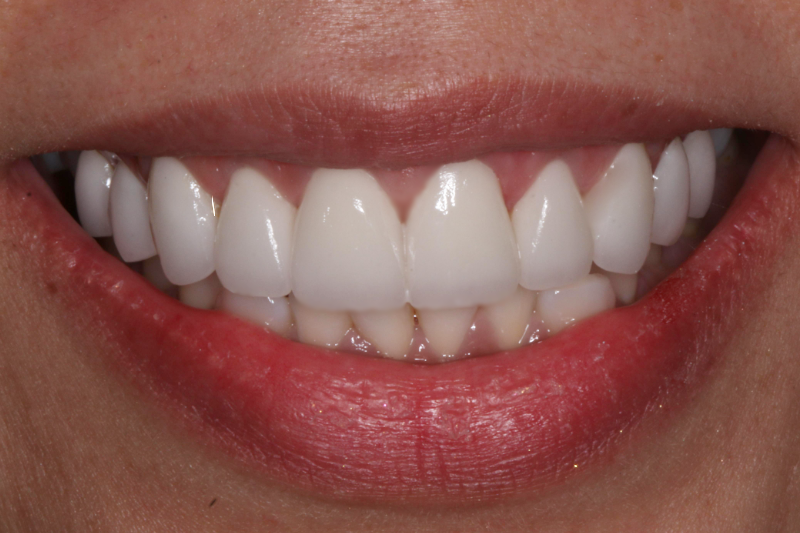 Veneers after