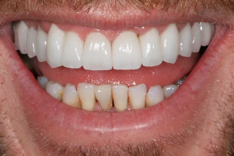 Porcelain Veneers