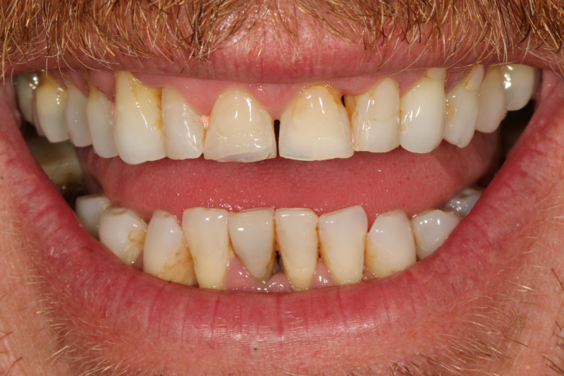 Before dental veneers