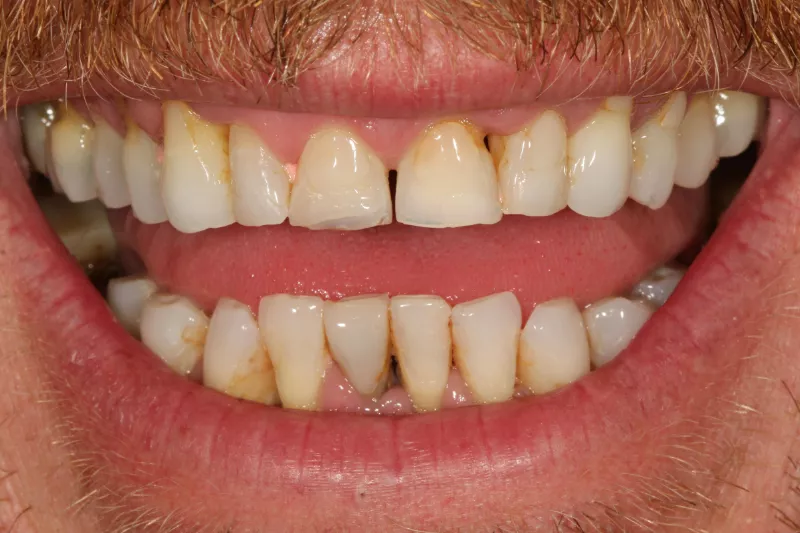Porcelain Veneers before