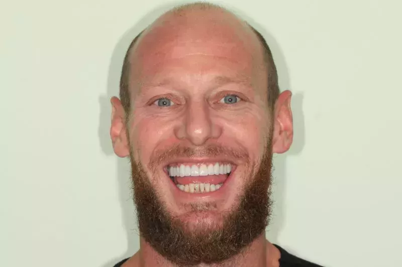 12 Porcelain Veneers