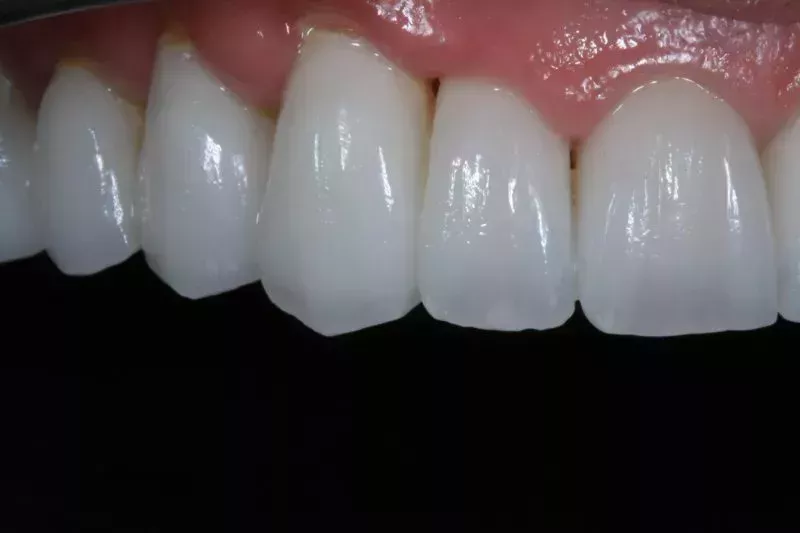 Painless non-cutting veneers at the Knightsbridge Clinic