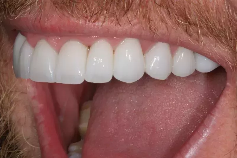 Natural looking veneers