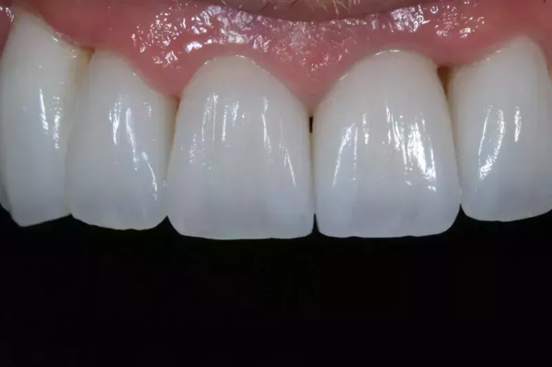 Smile Design by Dr Sheraz Aleem at the Knightsbridge Clinic