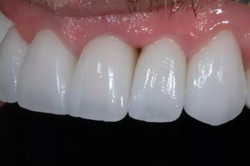 12 minimal prep veneers