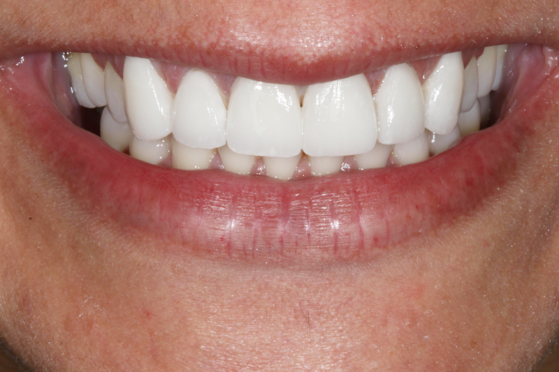 Porcelain Veneers