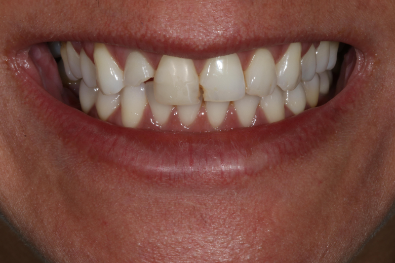 Before porcelain veneers