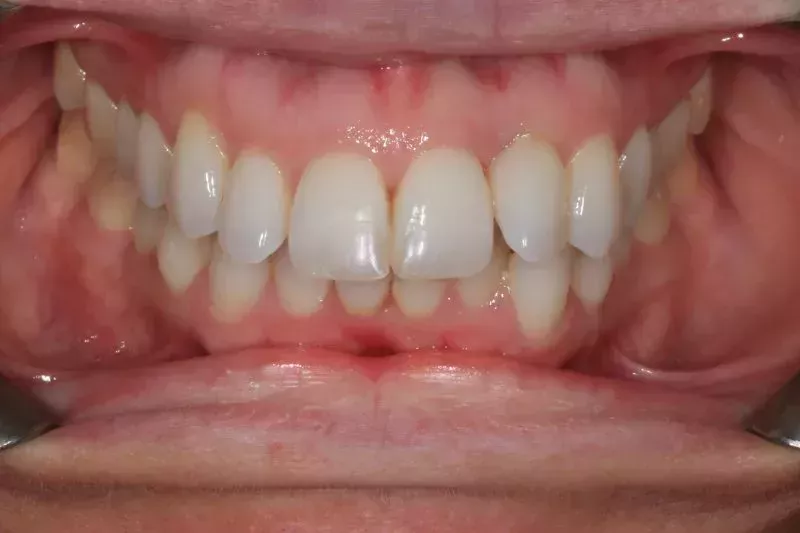 Composite bonding and Invisalign