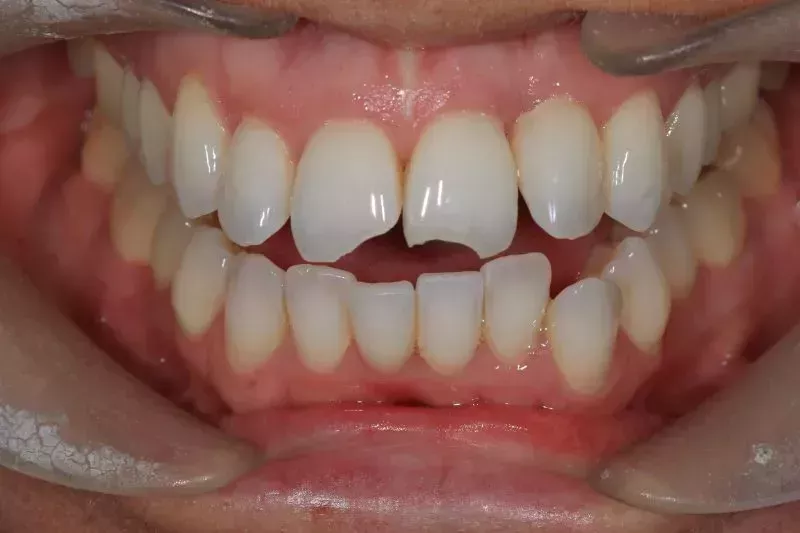 Composite and Invisalign before