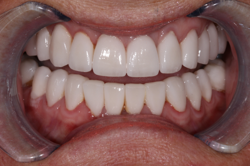 After dental veneers