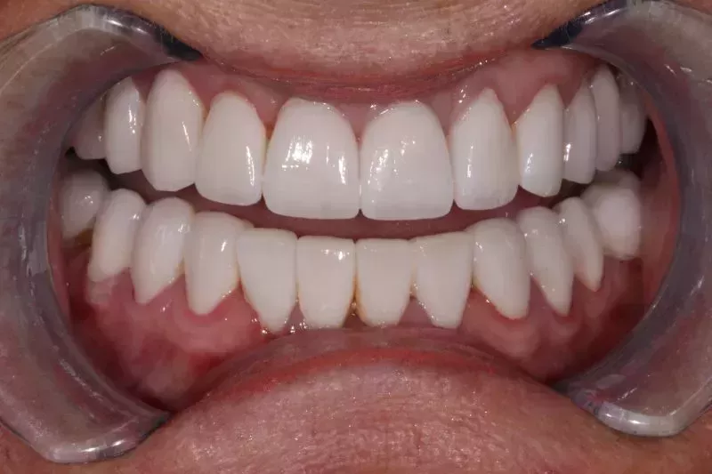 After dental veneers