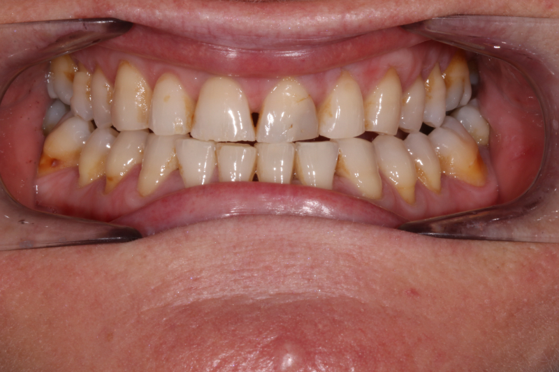 Before dental veneers