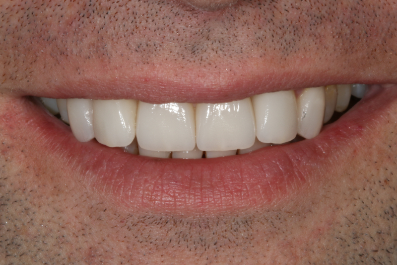 No more gaps with veneers