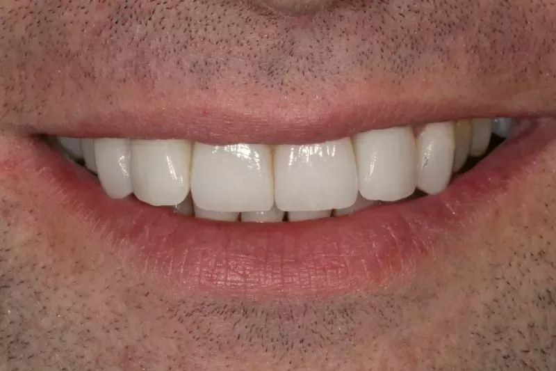 No more gaps with veneers