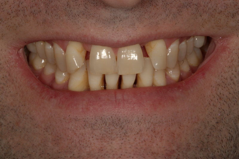 Fixing gappy teeth with veneers