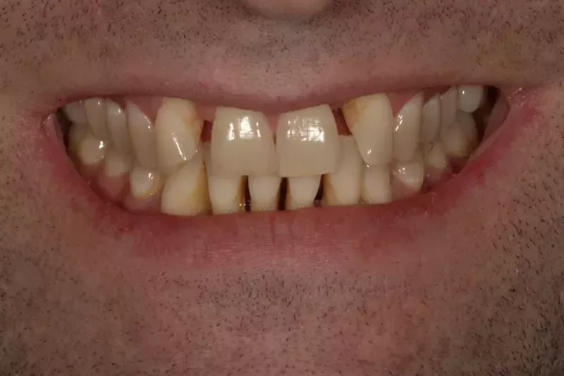 Fixing gappy teeth with veneers
