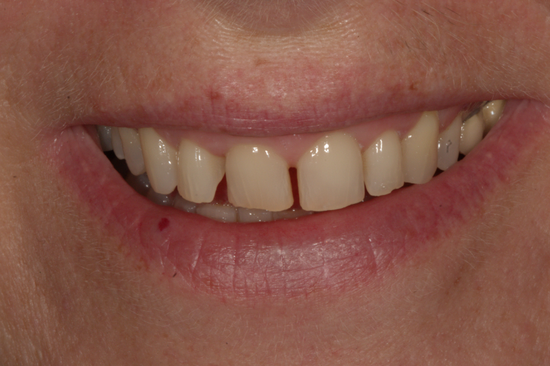 Porcelain Veneers