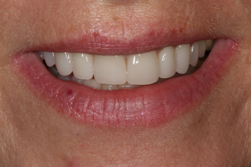 Veneers and crowns