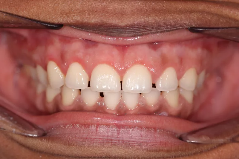 Gum contour with waterlase laser