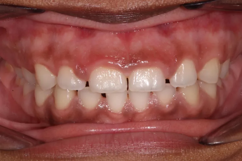 Gum contour with waterlase laser