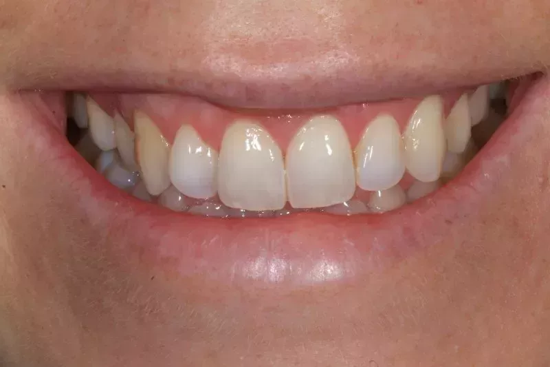 Gum contour after Waterlase laser