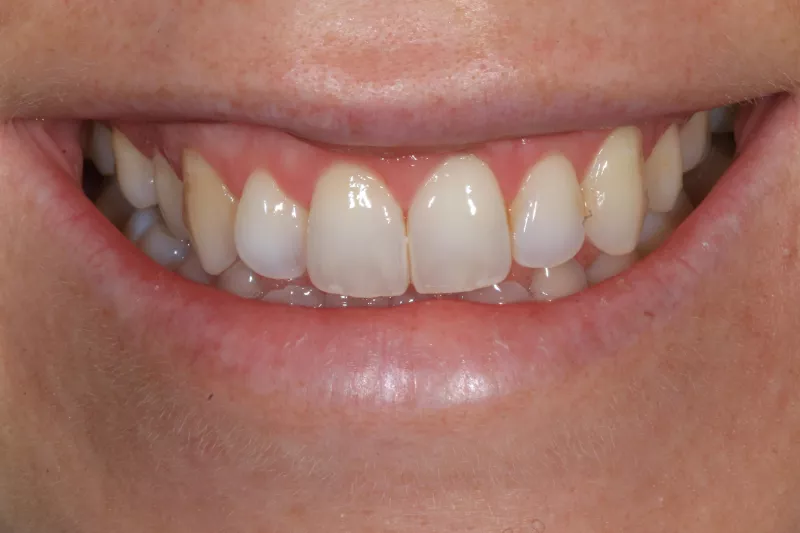 After gummy smile treatment